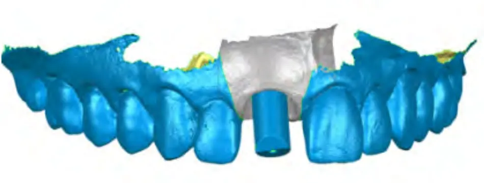 Figure	31	:	Résultat	numérique	d’assemblage	des	fichiers	comprenant	la	position	des	tissus	mous	et	 celle	de	l’implant	comme	décrit	dans	la	«	fully	digital	technique	».	