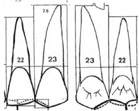 Figure 9 : faces vestibulaires et palatines de l’incisive latérale et de la canine du secteur 2[4]  En vue vestibulaire comme en vue palatine, on peut observer les deux points de  contacts
