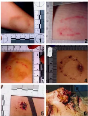 Figure 6: Photographies de morsures des différentes classes en fonction de la sévérité (21) 