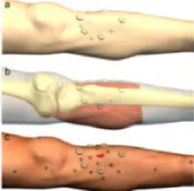 Figure 8: Schéma d'une technique par scanner avec des repères radio-opaques (30) 