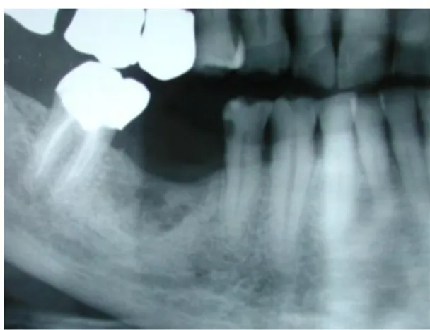 Figure 12 : Radiographie d’une ostéite mandibulaire au niveau du site extractionnel de la 46,  aspect osseux radiologique en « sucre mouillé »