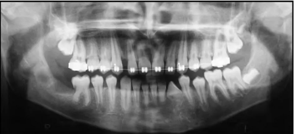 Fig.  1.  (13)    Radiographie  panoramique  montrant  chez  un  enfant  de  12  ans  une  canine 