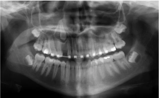 Fig.  3.   ( Service  d'odontologie  pédiatrique  -Toulouse)  Radiographie  panoramique  dentaire  d’une  jeune  fille  de  12  ans  montrant  une  canine  maxillaire  droite  incluse  atteinte  d’une  tumeur  odontogène adénomatoïde