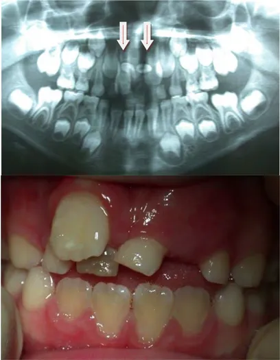 Fig.  22.  ( Service  d'odontologie  pédiatrique  -  Toulouse)  Dents  surnuméraires  11  bis  et  21  bis  responsables d’un retard d’éruption des 12, 21 et 22 et de l’éruption en position vestibulaire de la  11