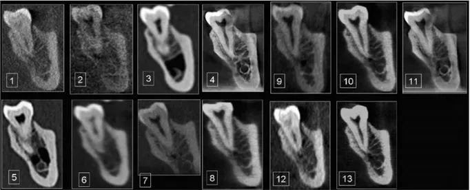 Figure 3 Différentes coupes du même objet selon différentes résolutions, filtres et marques de  CBCT