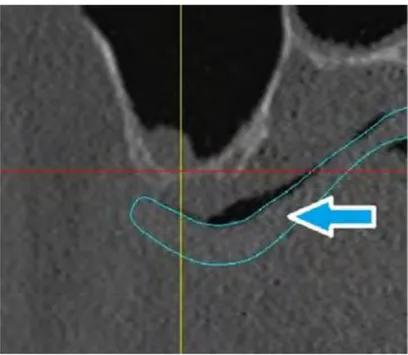 Figure 4 Epaisseur de tissus mous visible entre le guide radiologique (en bleu) et la surface  osseuse