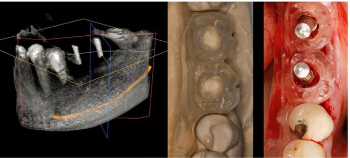 Figure 5 Logiciel de planification (Simplant ® ) avec guide radiologique et analyse des obstacles 