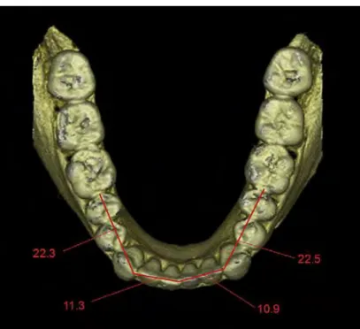 Figure 8 Evaluation des distances sur logiciel CBCT  19
