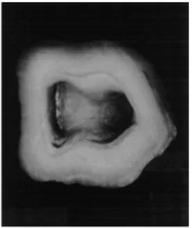 Figure 20 : Section d’une molaire mandibulaire au niveau de la jonction amelo-cémentaire  qui met en évidence la concentricité des parois de la chambre pulpaire avec les parois 