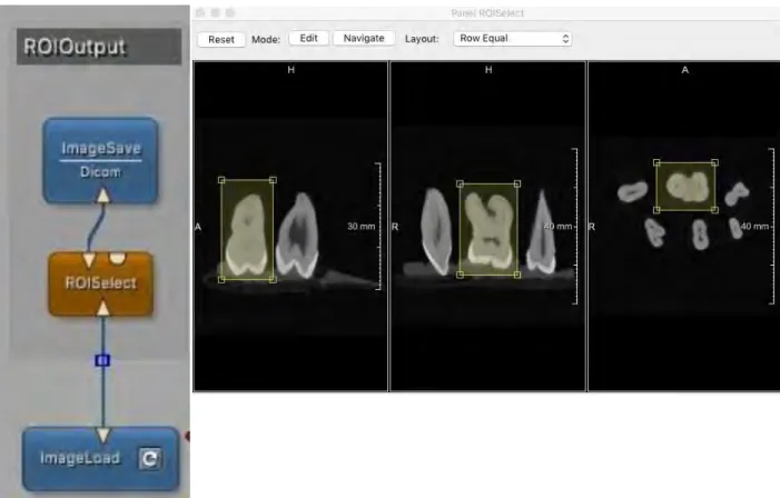 Figure 7 : Protocole MeVisLab® d'isolation d'une dent sur le volume CBCT initial contenant 6 dents