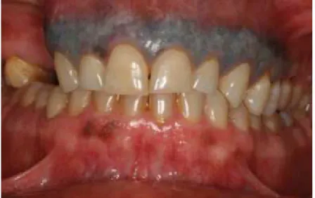 Figure 12. Gencive marginale maxillaire tatouée de 13 à 25 (BROOKS 2007)  