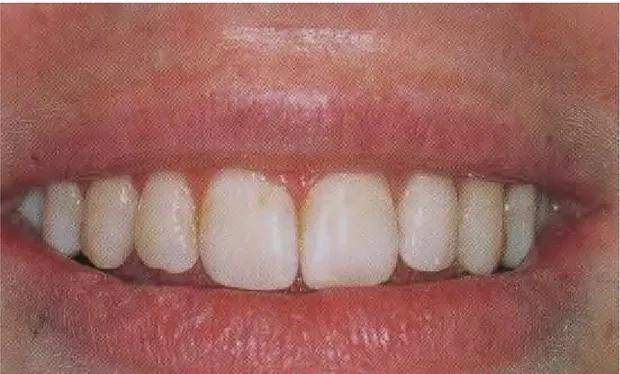 Figure 15. Ligne du sourire moyenne. 