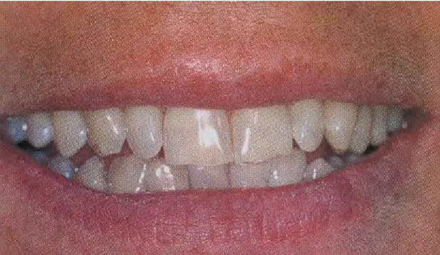 Figure 16. Ligne du sourire basse. 