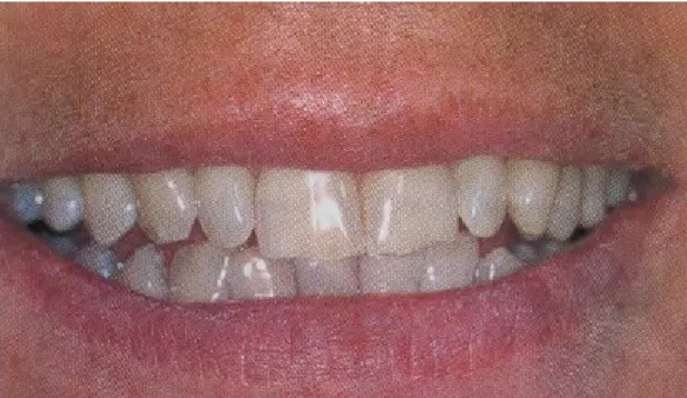 Figure 16. Ligne du sourire basse. 