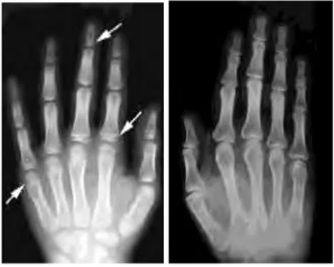 FIGURE 4: Radiographie  de la main d’un enfant de 8 ans (à gauche) et d’un adulte (à  droite).(4) 