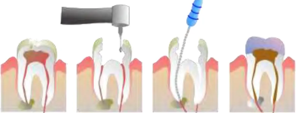 Fig 1 : le traitement endodontique conventionnel (Wikipédia.org) 