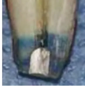 Fig 14 : Pénétration de bleu de méthylène à l’interface amalgame-dentine (75) 