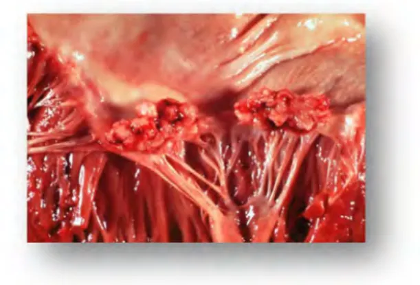 Figure 5 : Végétations observées  en bordure de valve cardiaque (1) 
