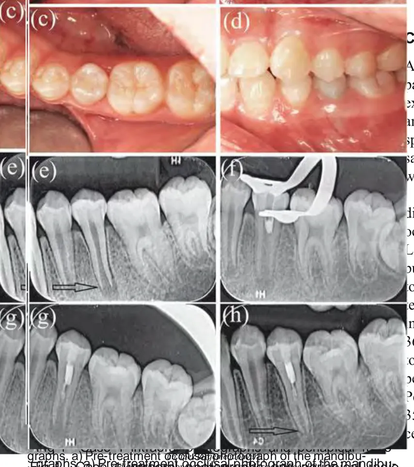 Fig 1    Case  1  intraoral  photographs  and  periapical  radio- radio-graphs. a) Pre-treatment occlusal photograph of the  mandibu-lar left second premomandibu-lar (tooth 35) with dens evaginatus and a  fractured occlusal  tubercle (arrow); b) pre-treatment  intraoral  photograph of tooth 35, showing swelling and redness on the  buccal mucosa (arrow); c) occlusal photograph at the 8-month  follow-up; d) intraoral photograph at the 8-month follow-up; e)  pre-treatment  periapical  radiograph  of  tooth  35  showing  the  periapical  radiolucency  and immature root (arrow); f)  cal  radiograph  taken  during  iRoot  BP  placement;  g)  periapi-cal  radiograph  taken  after  completion  of  the  iRoot  BP  filling  at  the  first  treatment  visit;  h)  periapical  radiograph  taken  at  the  8-month  follow-up;  the  root  canal  was  lengthened,  the  root wall had thickened and the apical foramen had narrowed  (arrow).