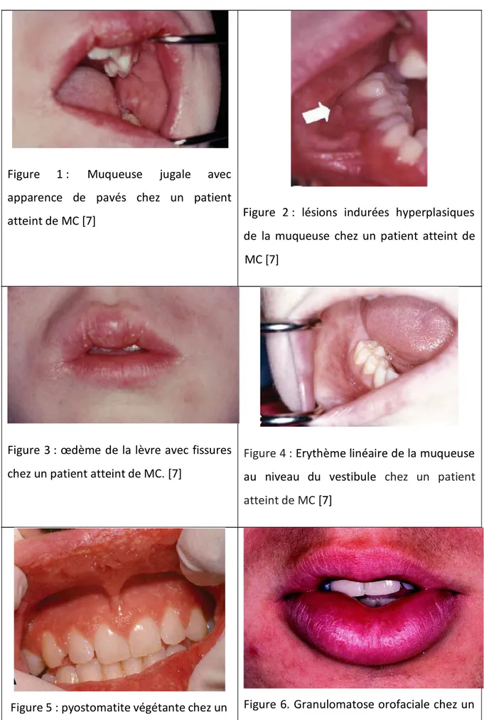 Figure  1 :  Muqueuse  jugale  avec 