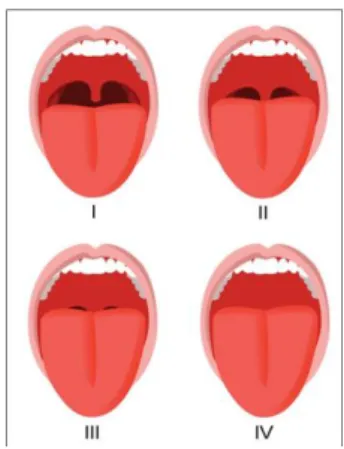 Fig. 3: Classification de Mallampati  [92] 