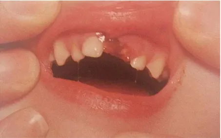 Figure	
  28	
  :	
  Photo	
  d'une	
  expulsion	
  dentaire	
  chez	
  un	
  enfant	
  de	
  4	
  ans	
  (53)	
   	
  