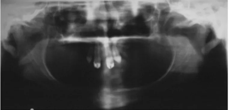 Figure	
  36	
  :	
  Orthopantomogramme	
  d'un	
  patient	
  atteint	
  de	
  dysplasie	
   ectodermique	
  anhidrotique	
  (30)	
  