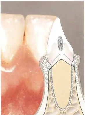 Figure 2. Gingivite. (Figure issue de Wolf et al. (1)) 