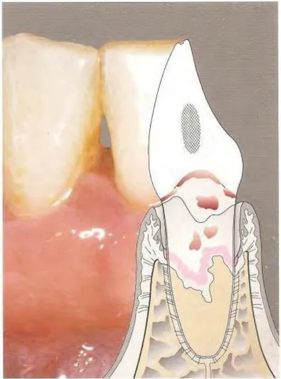 Figure 3. Parodontite. Noter la schématisation de la poche, la présence  - dans ce cas -, de tartre  supra- et sous-gingival, ainsi que la destruction des tissus profonds