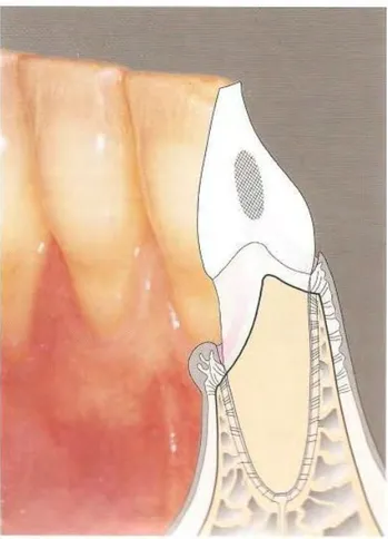 Figure  4. Récession. Dans ce  cas, pas de  poche ;  l'ensemble  des  tissus parodontaux a  migré  en  direction apicale