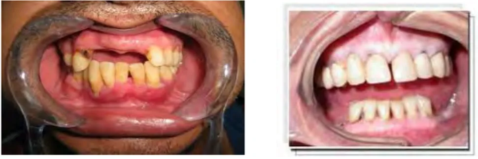 Figure	
  3a	
  et	
  b-­‐	
  Edentement	
  intercalaire	
  et	
  Edentement	
  terminal	
  postérieur	
  (16)	
  