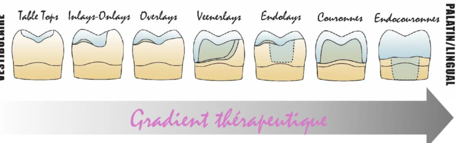 Figure 5 : Différents designs de préparations pour restaurations postérieures en fonction du gradient thérapeutique :  table-tops, inlays, onlays, overlays, veenerlays, endolays, couronnes et endocouronnes