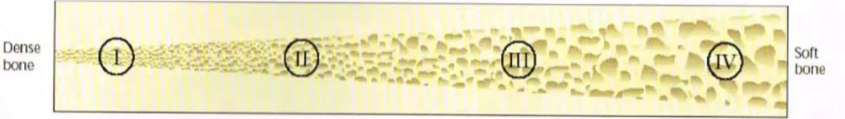 Figure 7 : Image illustrant le gradient de densité osseuse, d’après Albrektsson et Zarb (1989)
