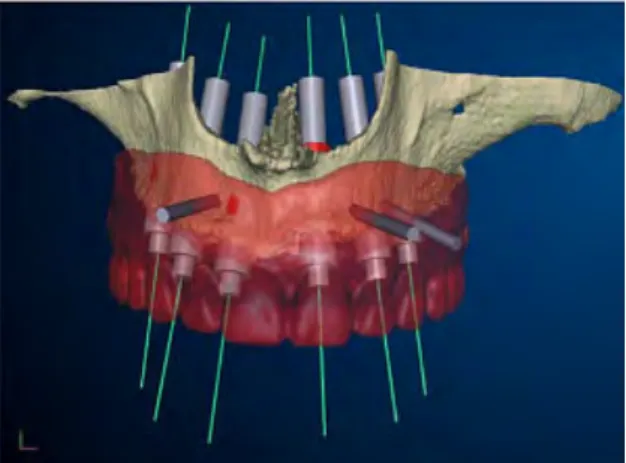 Figure 13 : Image illustrant la planification implantaire virtuelle de l’intervention chirurgicale  (logiciel Procera®)