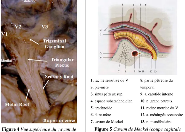 Figure 5 Cavum de Meckel (coupe sagittale  schématique) [38]. 