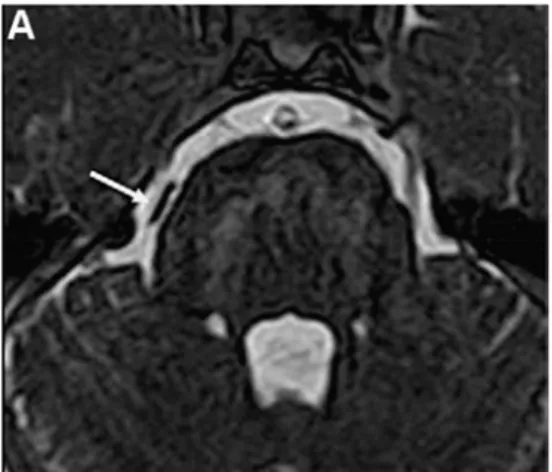 Figure 7 IRM-3D-T2 haute résolution montrant un simple contact de l’artère cérébelleuse 