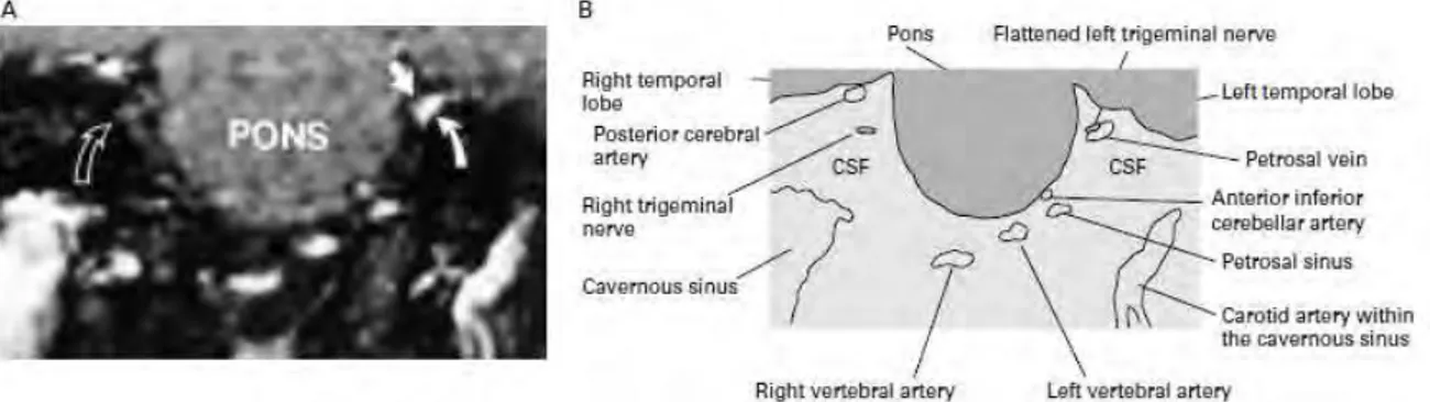 Figure 9 ARM montrant une compression du nerf trigéminal gauche par la veine pétreuse (A) et  schéma de cet ARM (B) [12]