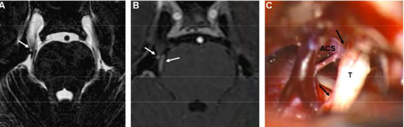 Figure 10 Etude des images produites avec l’IRM-3D-T2 haute résolution (A) et l’ARM-TOF-3D  (B) et comparaison avec les relevés effectués durant la chirurgie (C) montrant une compression du  nerf (T) par l’artère cérébelleuse supérieure (ACS)
