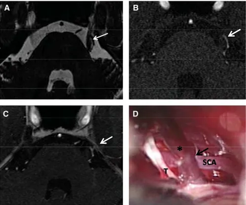 Figure 12 Etude des images produites chez un même patient avec l’IRM-3D-T2 (A), l’ARM-TOF- l’ARM-TOF-3D (B) et l’IRM-l’ARM-TOF-3D-T1avec injection de gadolinium (C) et comparaison avec les relevés effectués  durant la chirurgie (D) montrant une compression du nerf (T) par l’artère cérébelleuse supérieure 