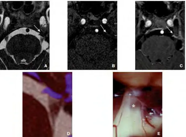 Figure 13 Etude des images produites chez un même patient avec l’IRM-3D-T2 haute résolution  (A), l’ARM-TOF-3D (B), l’IRM-T1 avec injection de gadolinium (C) et la fusion des IRM  3D-T2 haute résolution et 3D-T1 avec injection de gadolinium