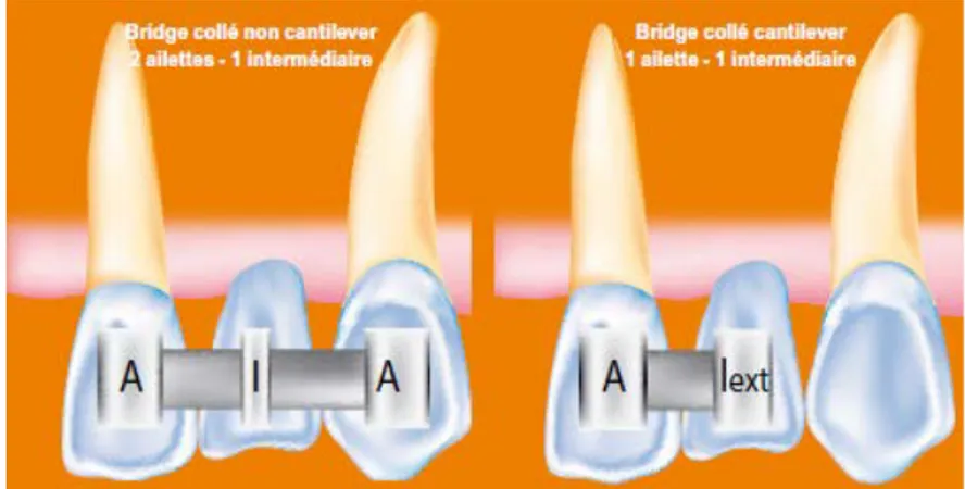 Figure 8 : Préparation tissulaire nécessaire selon la technique prothétique utilisée, avec le bridge collé cantilever  
