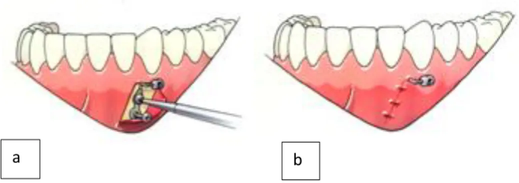 Fig 9 : fixation de la 2 nde  vis (a) et suture du lambeau (b) (Source : hugodeclerck.net) 