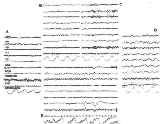 Figure 1   Aspect E.E.G du sommeil chez l’homme  a) Eveil, avec rythme alpha; b) Stade  1: activité rapide de bas voltage, à l'endormissement; c) Stade 2: fuseaux; d) Stade 4:  ondes lentes; e) P.P.: activité de bas voltage, ondes lentes rythmiques antérieures, &#34;en 