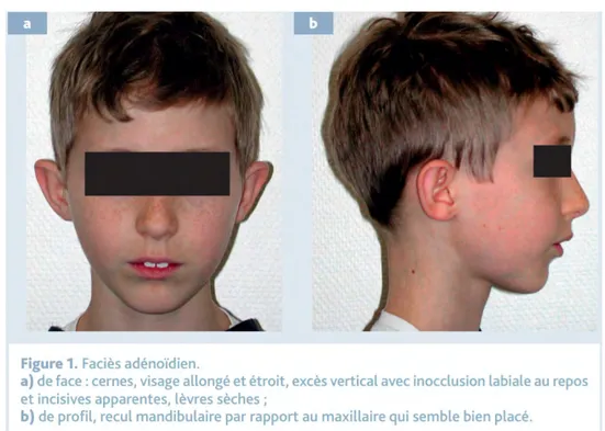 Figure 5 Phénotype du respirateur buccal Place des traitements d’orthopédie dentofaciale  dans l’apnée du sommeil pédiatrique 