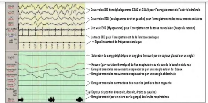 Figure 6 L’examen polysomnographique 