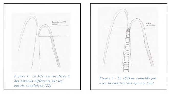 Figure 5 : Formes canalaires  possibles au niveau apical [ 20]  Figure 3 : La JCD est localisée à 