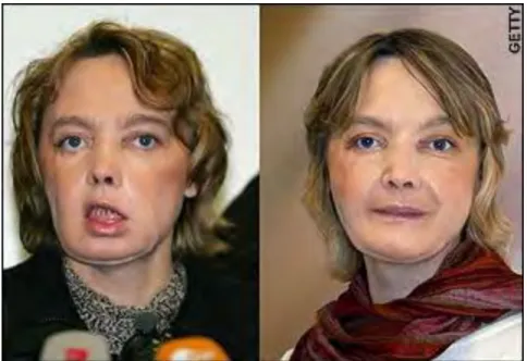 Figure 3:  Isabelle Dinoire underwent the groundbreaking operation, the telegraph 