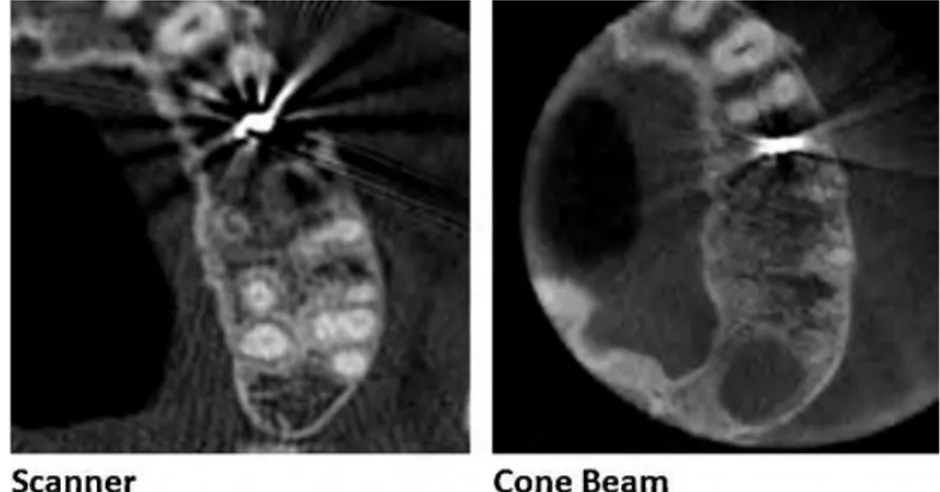 Figure 4 : Artéfacts métalliques du scanner supérieurs à ceux du Cone Beam (même patient) 