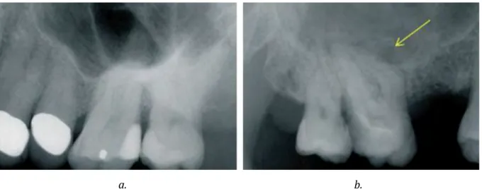 Figure 5 : a. l’arche zygomatique obscurcit l’anatomie apicale de ces molaires maxillaires 