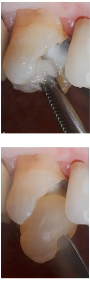 Figure 7 : La cavité, dans laquelle une hybridation dentinaire  immédiate a été réalisée, est enduite de glycérine 